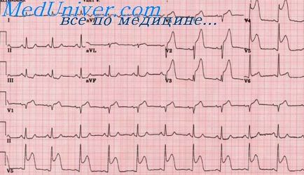 Infarct miocardic multifocal - tratament cardiac