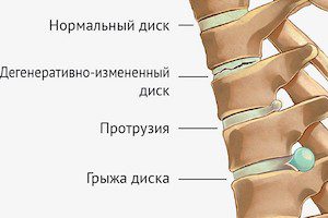 Чи може костоправ вилікувати грижу хребта