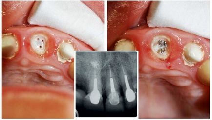 Extinderea unui dinte pe un bolț de o tehnică de instalare, tipuri de material și forme, prețul