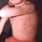 Metode tradiționale de tratare a contagiosului molluscum - bisturiu - medical