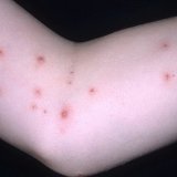 Metode tradiționale de tratare a contagiosului molluscum - bisturiu - medical