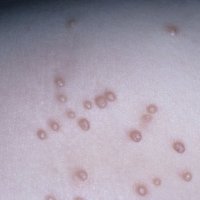 Metode tradiționale de tratare a contagiosului molluscum - bisturiu - medical