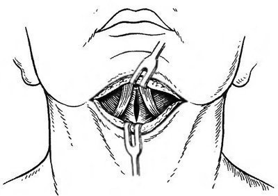 Abcesul abdominal