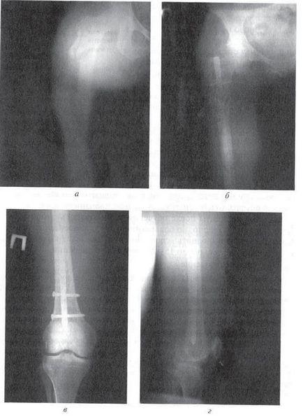 Tratamentul operativ al fracturilor închise ale oaselor tubulare lungi