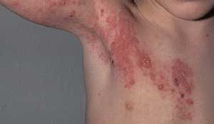 Tinea-psoriazis simptome și de tratament la domiciliu