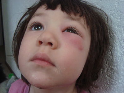 Опух очей від укусу комара у дитини що робити