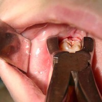 Ускладнення після видалення зуба мудрості нижня щелепа, наслідки, гематома, синець, лікування зубів