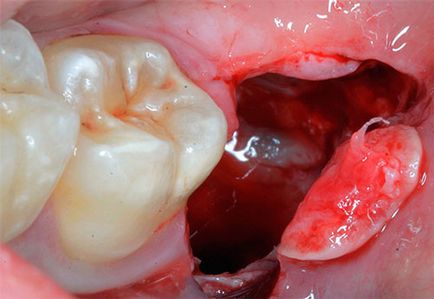 Szövődmények eltávolítása után bölcsességfog az alsó állkapocs, a következmények, vérömleny, zúzódás, fogászati ​​kezelés