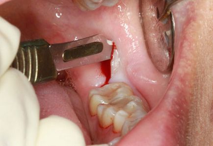 Complicații după îndepărtarea unui dinte de înțelepciune a maxilarului inferior, consecințe, o vânătaie, o vânătă, tratamentul unui dinți