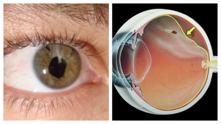 Основні причини і лікування крововиливу в око загальні рекомендації