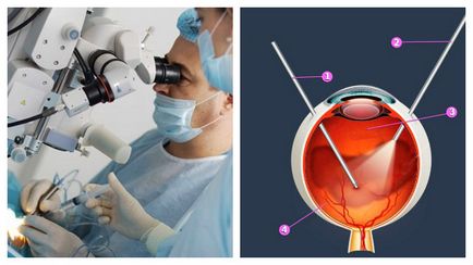 Cauzele principale și tratamentul hemoragiei în ochi sunt recomandări generale