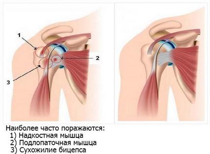 Основні причини, що викликають біль в спині між лопатками