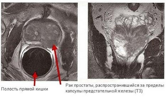 Caracteristicile unui dispozitiv automat de biopsie a prostatei