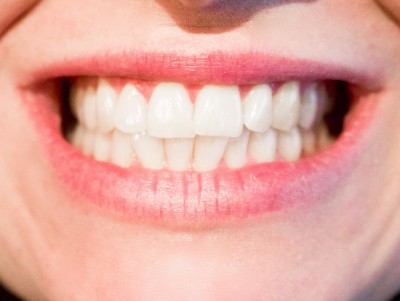 Відбілювання та чистка зубів - обласний клінічний стоматологічний центр