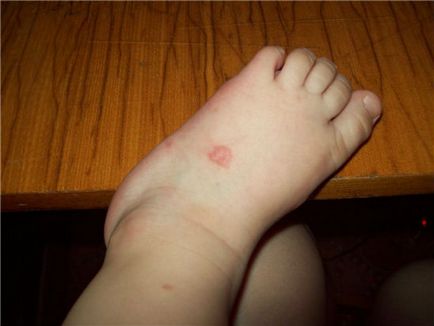 Umflarea unei mușcături de țânțari la un copil - ce măsuri trebuie luate