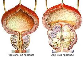 Edemul prostatei, diagnosticul, tratamentul, cauzele