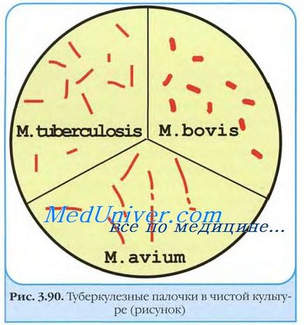 Anatomia patologică a tuberculozei