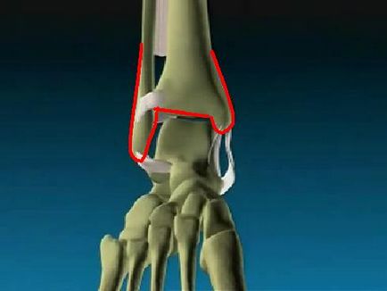 Fracturile gleznelor - acuarelă clinică chirurgie plastică