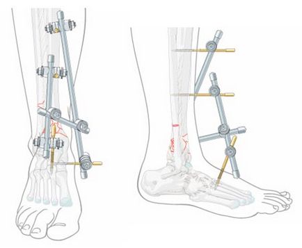 Törések a boka - Plasztikai sebészet klinika akvarell
