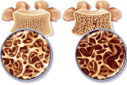 Nutriție pentru osteoporoza oaselor și a coloanei vertebrale
