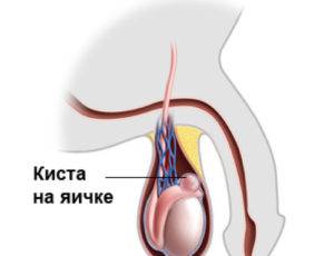 Наслідки кісти яєчка у чоловіків, якщо не лікувати, чи можна займатися спортом при кісті яєчка