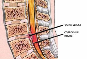 Поперековий остеохондроз ознаки, симптоми, діагностика, лікування, гімнастика