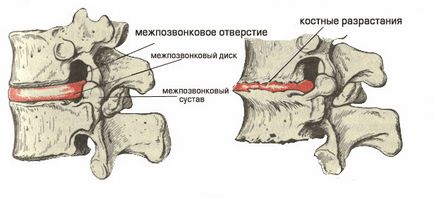 Поперековий остеохондроз ознаки, симптоми, діагностика, лікування, гімнастика