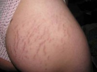 Cauzele apariției vergeturilor pe piele în perioada adolescenței