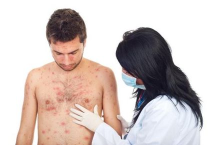 Vaccinul împotriva varicelei - indicații pentru imunizarea adulților și a copiilor