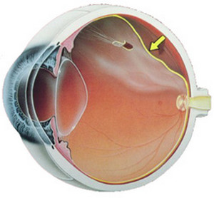 Semne de detașare a retinei în fotografie, cauze, efecte și tratament