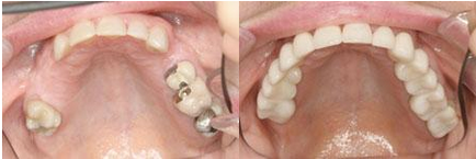 Protetica dinților în lublino în clinica dentară 