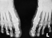 Acropatia pseudosirinomyelitică - cauze, simptome, diagnostic și tratament