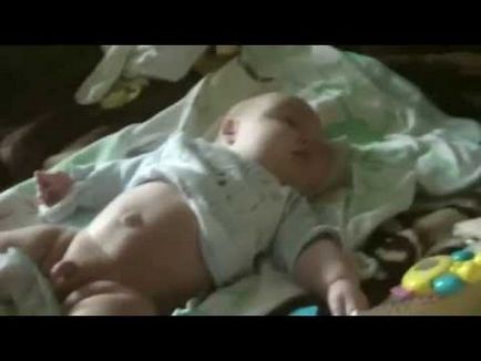 O hernie ombilicală la nou-născuți