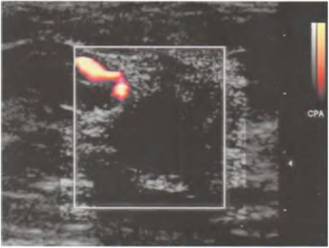 Emlőrák - emlő ultrahang