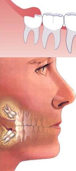 Зростає зуб мудрості і болить що робити в домашніх умовах - зростає зуб мудрості що робити,