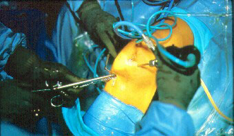 Ruptura ligamentului cruciat, refacerea dupa interventie chirurgicala pe cruce - (ligamente crucifice)