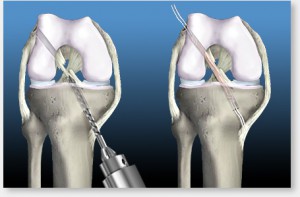 Ruptura ligamentului cruciat anterior al articulației genunchiului