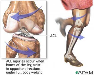 Ruptura ligamentului cruciat anterior al articulației genunchiului