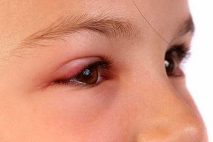 Дитину вкусила мошка в око - що робити і чим зняти набряк, якщо опухло повіку