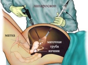 Refacerea indicației ovarelor pentru chirurgie, rezecție parțială și sferoidă