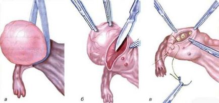 Refacerea indicației ovarelor pentru chirurgie, rezecție parțială și sferoidă