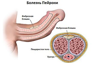 Сам вилікував хвороба Пейроні чи можливо