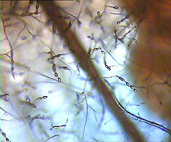 Seborrhea - cauze, simptome, diagnostic și tratament