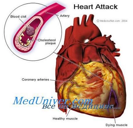 Astmul cardiac și edemul pulmonar - tratament cardiac