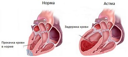 Simptome și tratament pentru astmul cardiac, ce este?