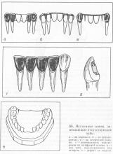 Proteze anticorpi și proteze, periodontită și periodontită, tratamentul bolilor parodontale