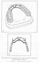 Proteze anticorpi și proteze, periodontită și parodontită, tratamentul bolilor parodontale