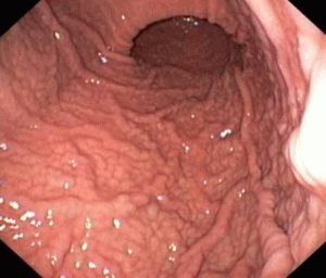 Simptomele gastritei și ulcerului gastric la adulți