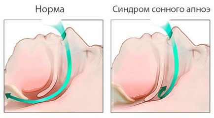 Синдром апное уві сні що це таке