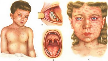 Erupții la rujeola la copii, simptome, tratament
